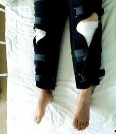 腿骨折的明星,腿骨折明星的康复之路